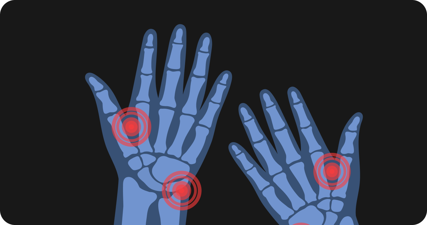 手のむくみの原因のひとつが関節炎である様子